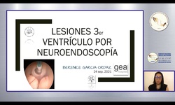 Lesiones de 3er ventrículo por neuroendoscopia